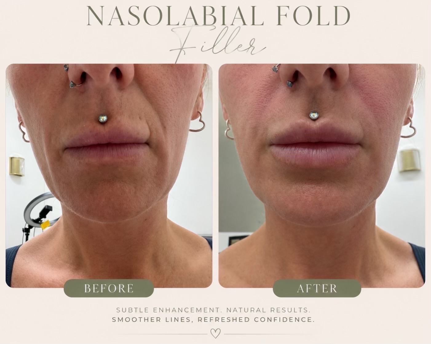 Before and after 0.6ml nasolabial folds filler