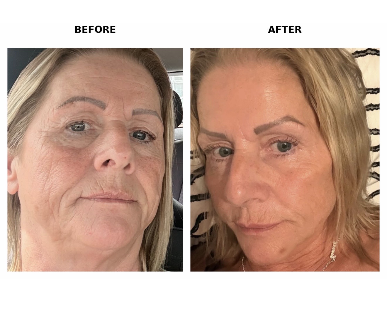 Before and after 3ml face filler and 3 areas of anti-wrinkle treatment