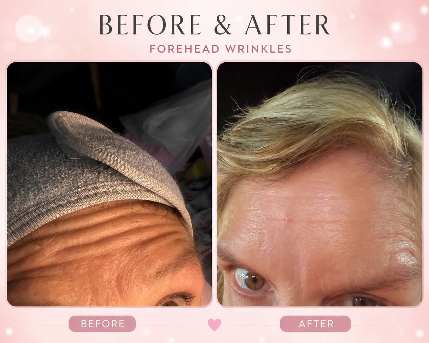 Before and after 3 areas of anti-wrinkle treatment