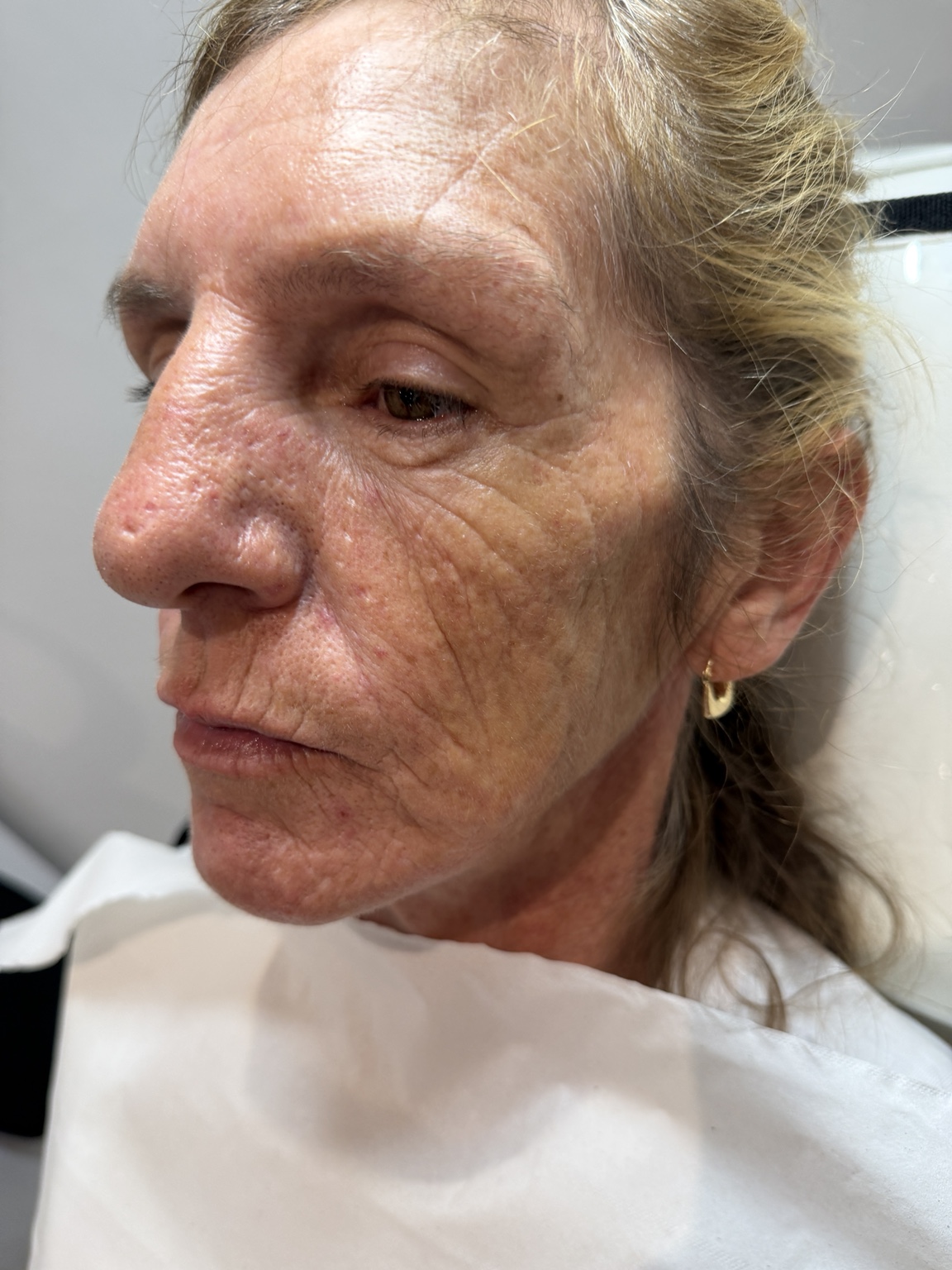 After 2ml cheek filler