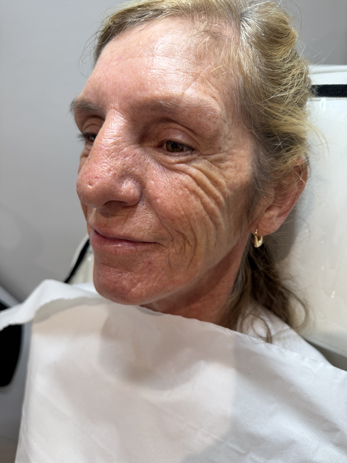 Before 2ml cheek filler