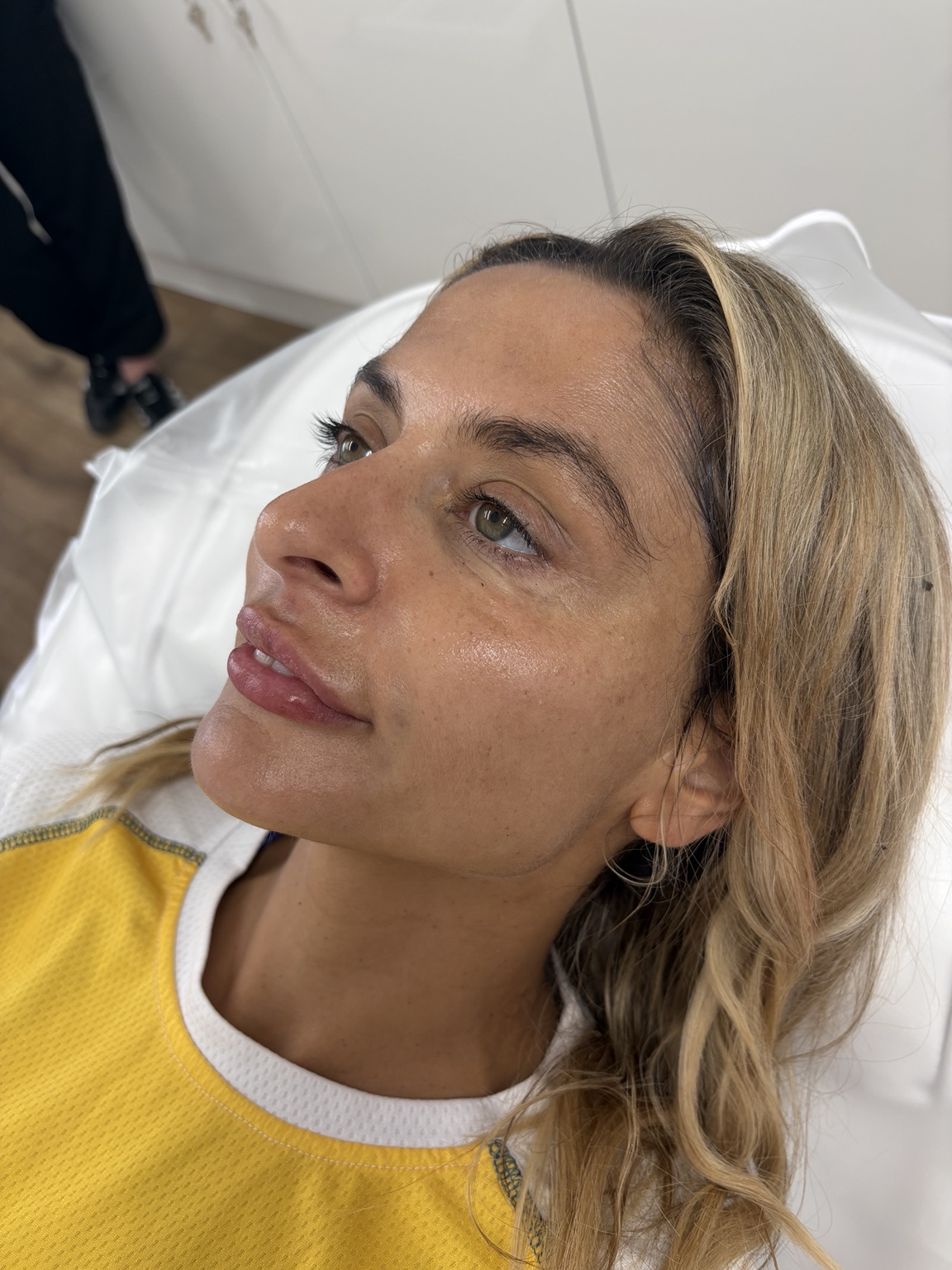 After chemical peel treatment