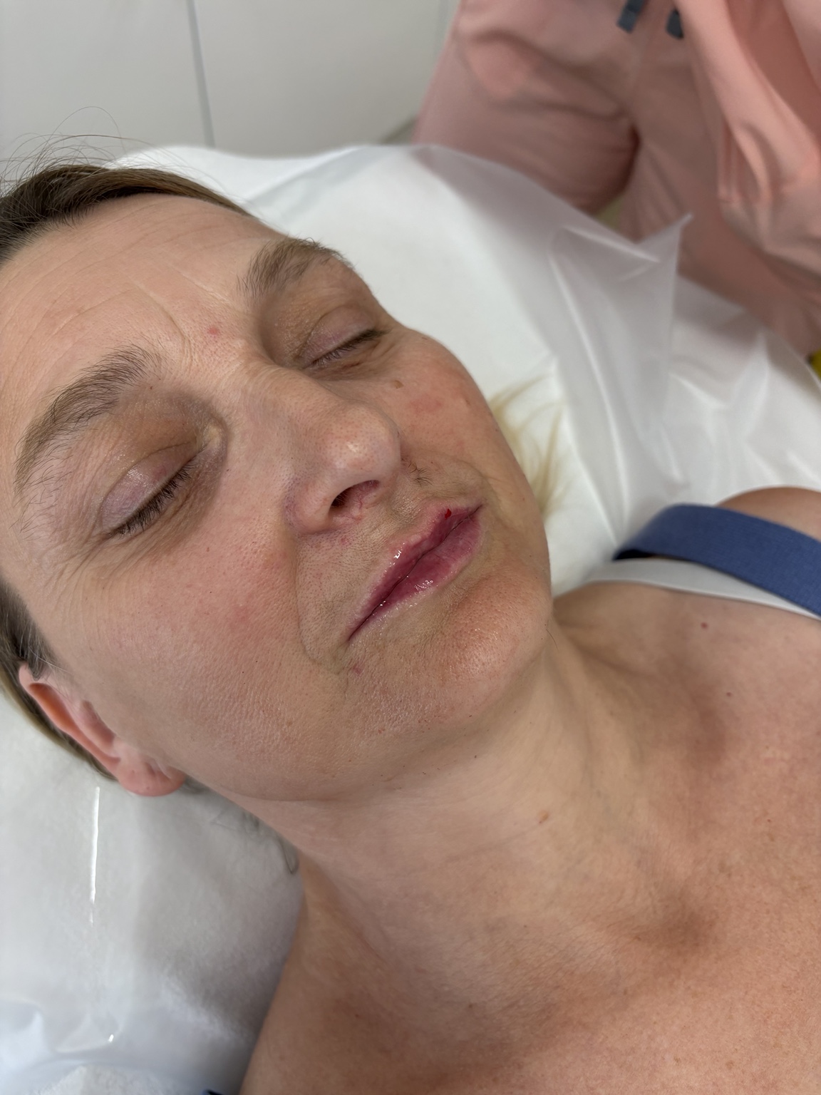 After 0.5ml filler treatment