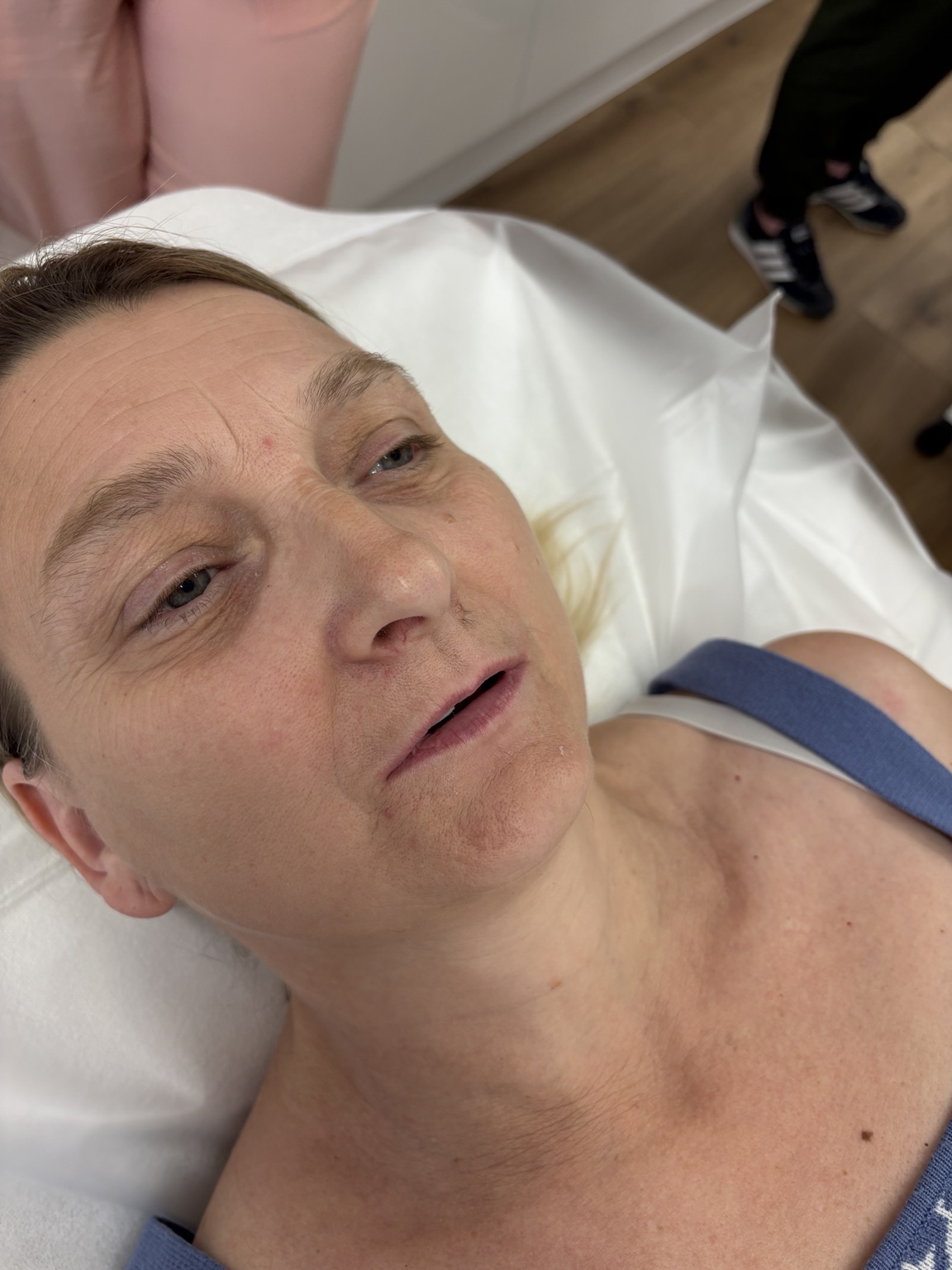 Before 0.5ml filler treatment