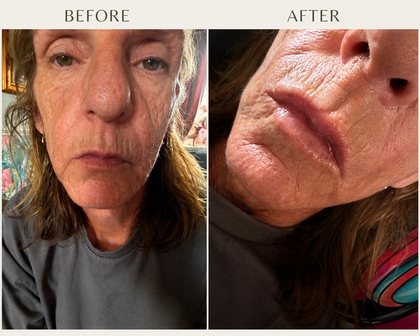 Before and after 0.5ml lip filler