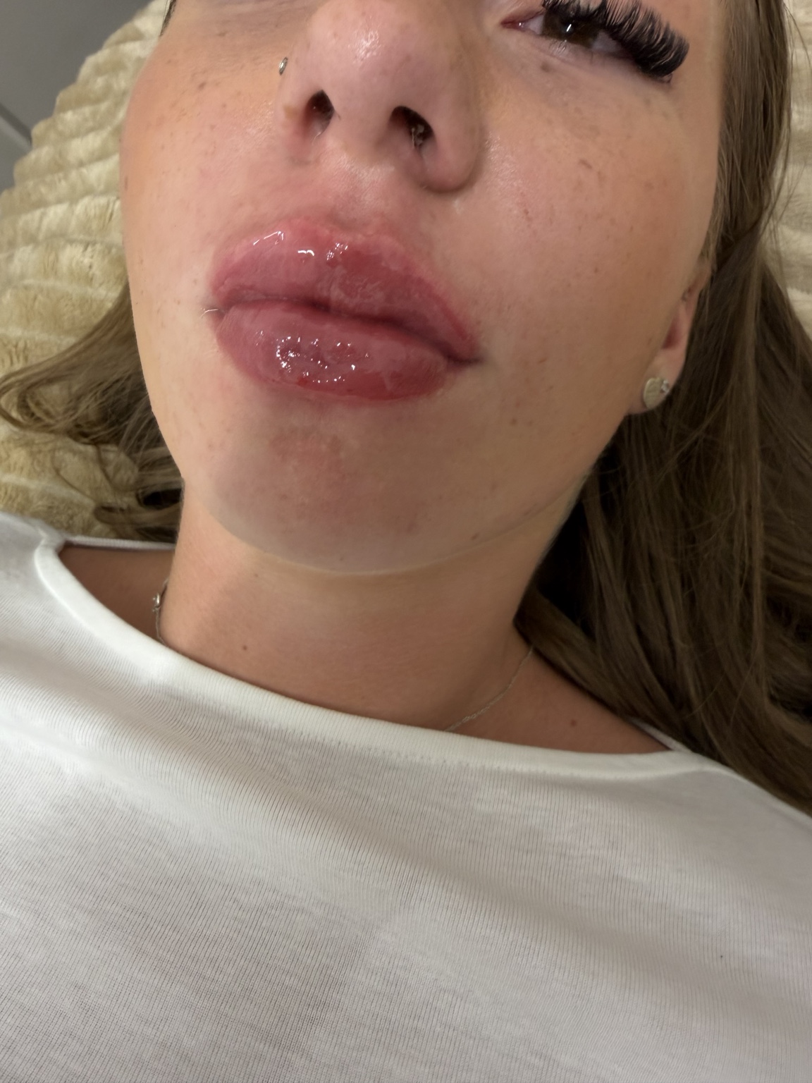 After 0.8ml top lip filler