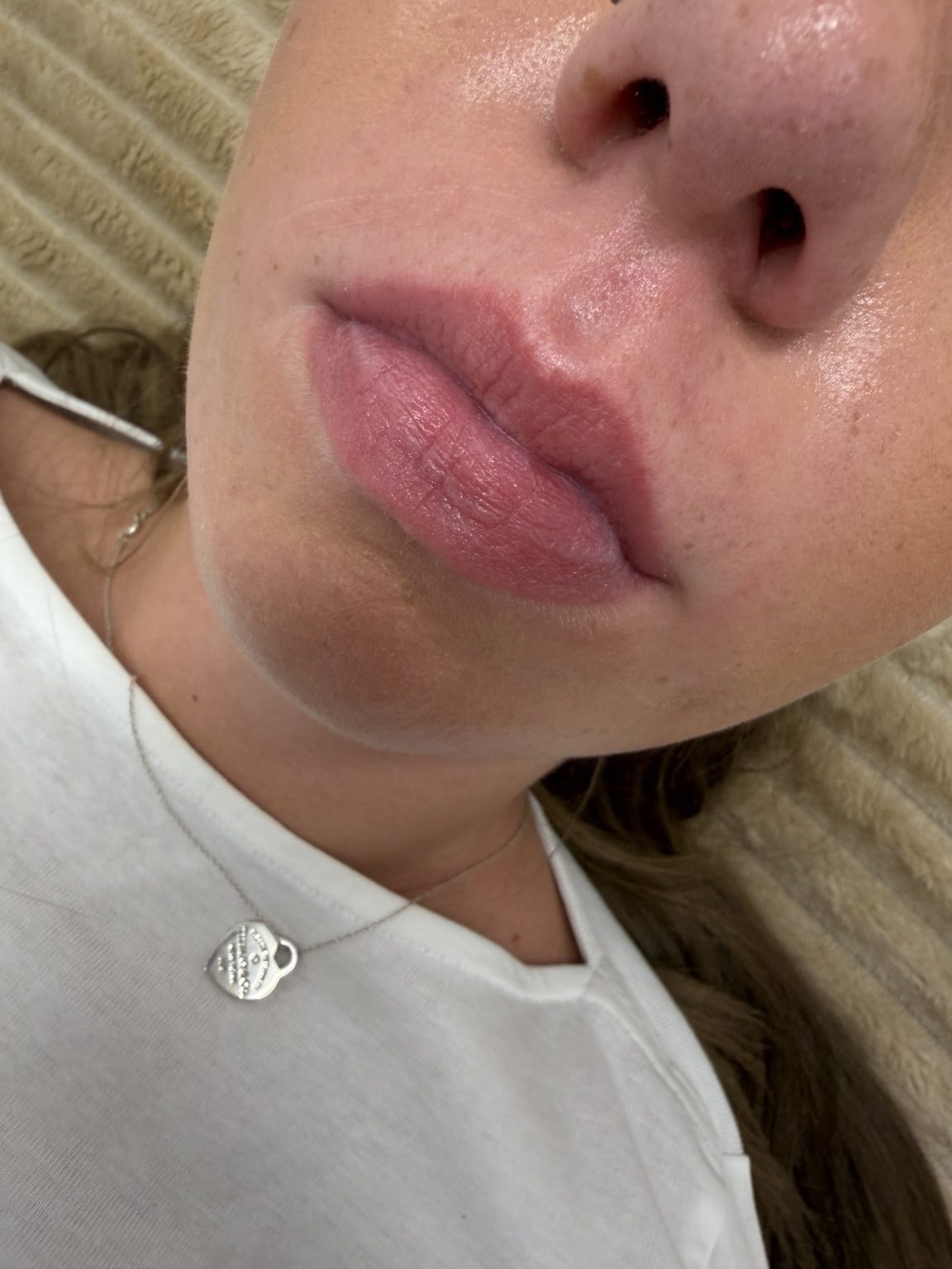 Before 0.8ml top lip filler