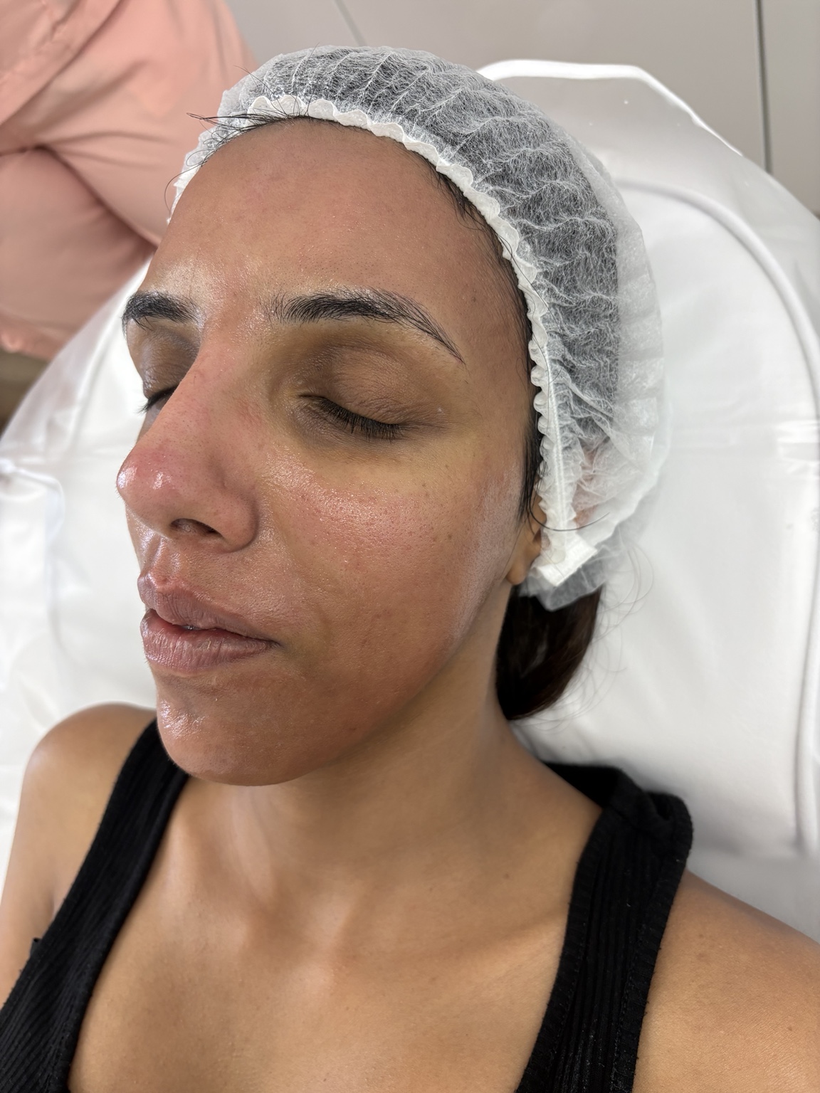 After microneedling treatment