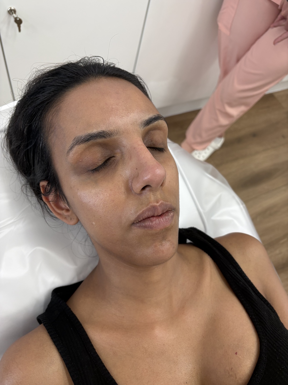 Before microneedling treatment