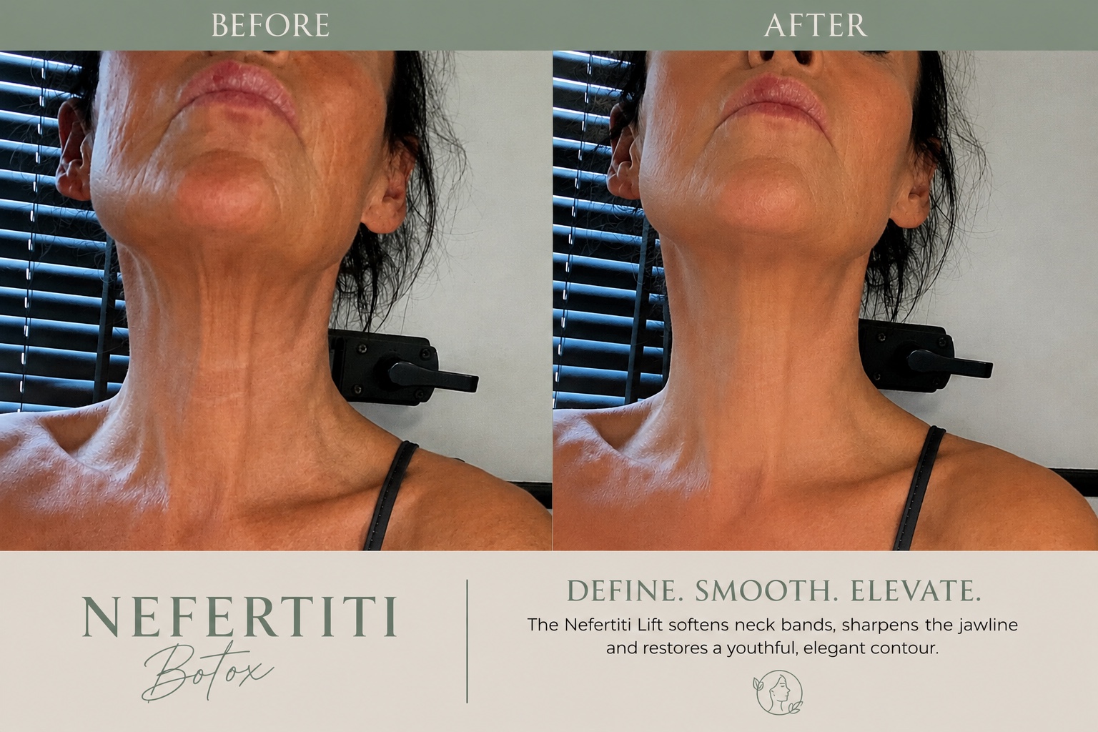 Before and after Nefertiti treatment