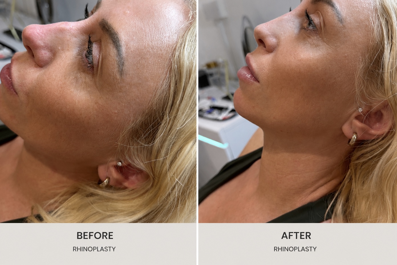 Before and after non-surgical rhinoplasty