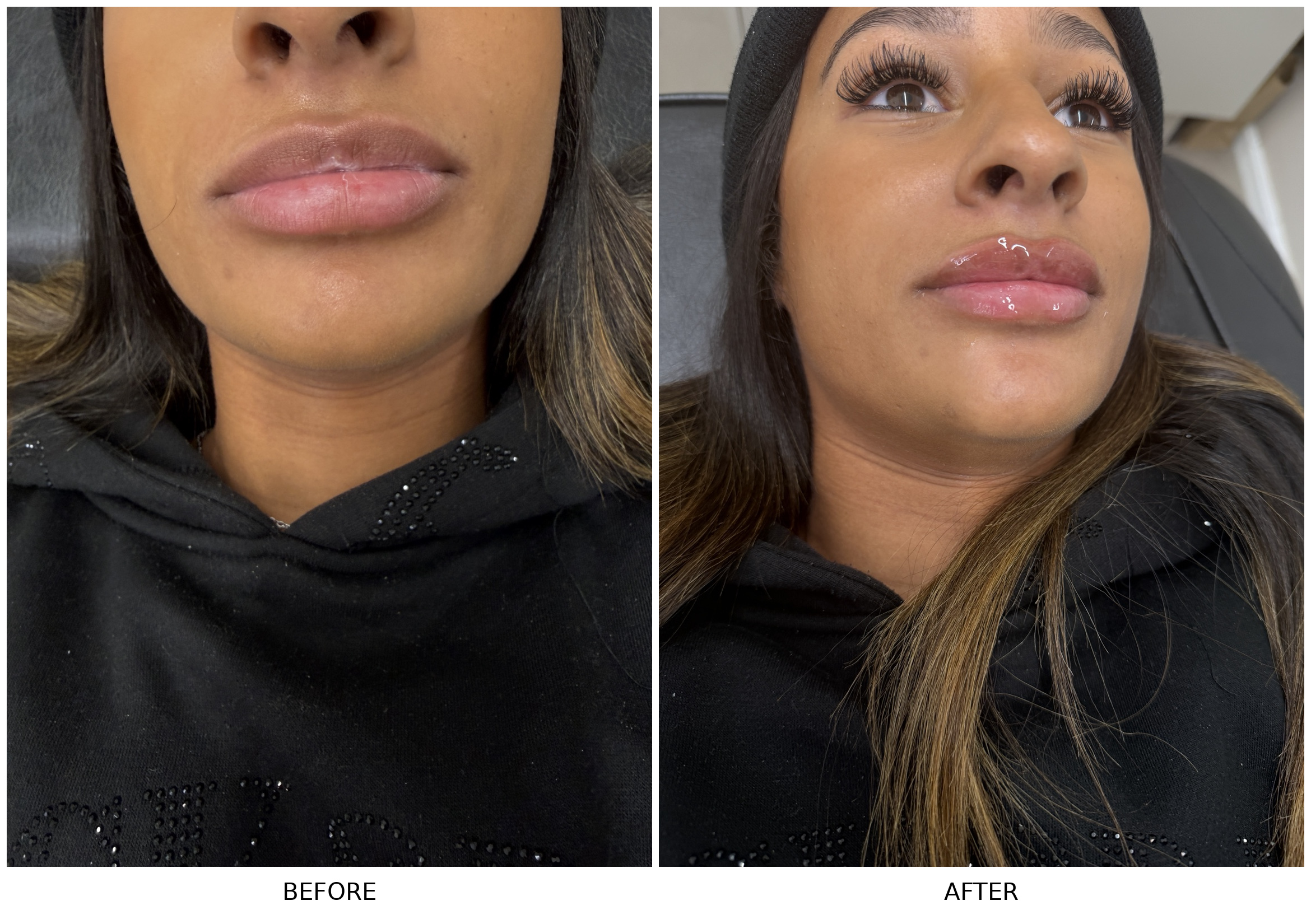 Before and after 0.5ml top lip filler