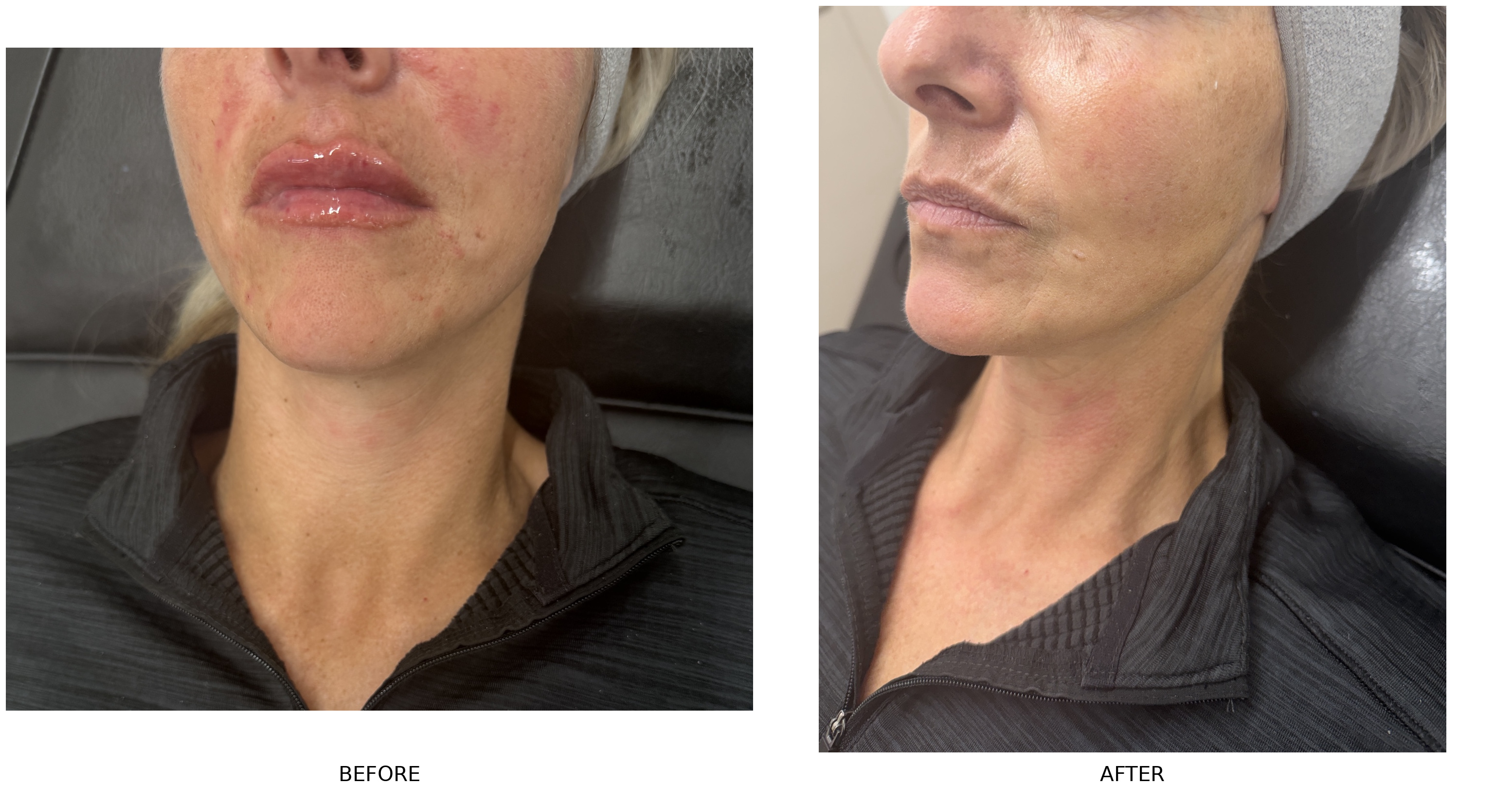 Before and after 1ml filler package in the lips and nasolabial folds