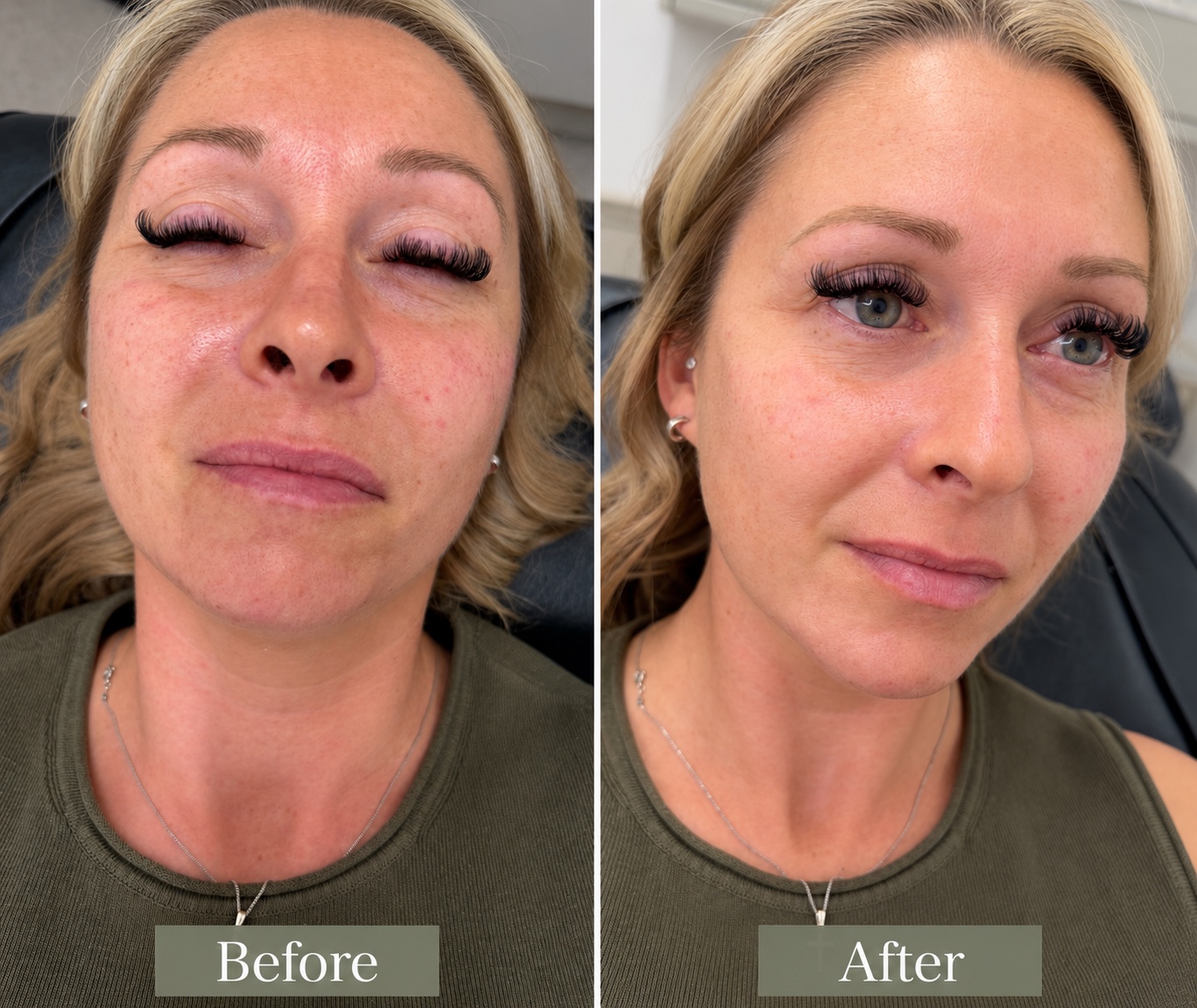 Before and after 3ml facial balancing package in the cheeks, jawline and chin