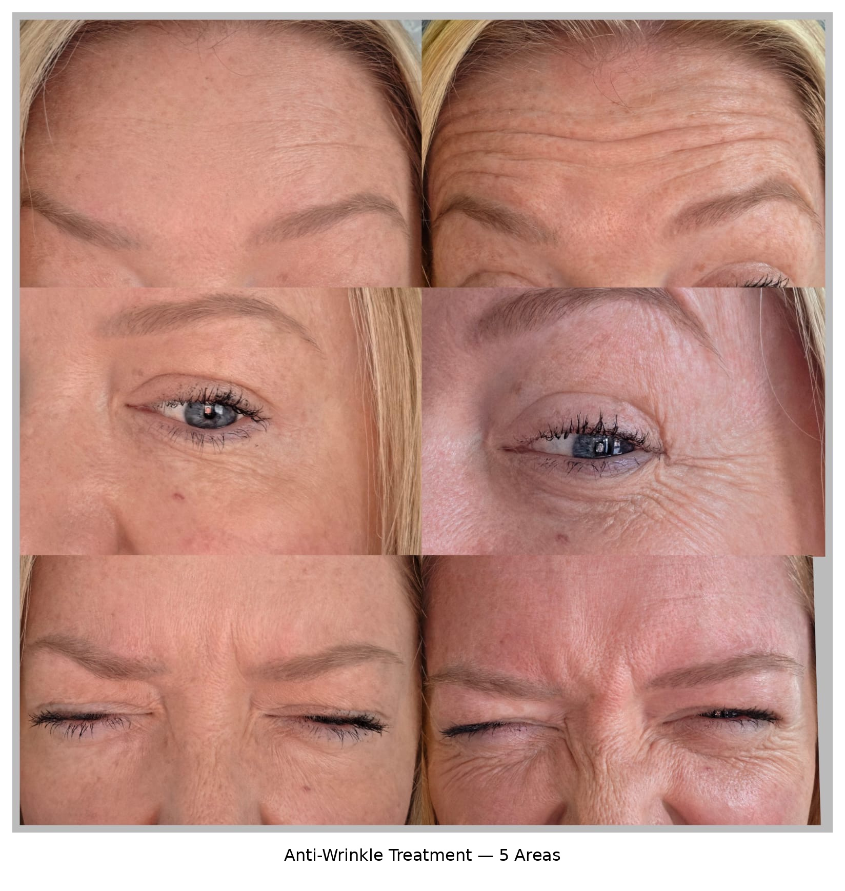 Before and after five-area anti-wrinkle treatment