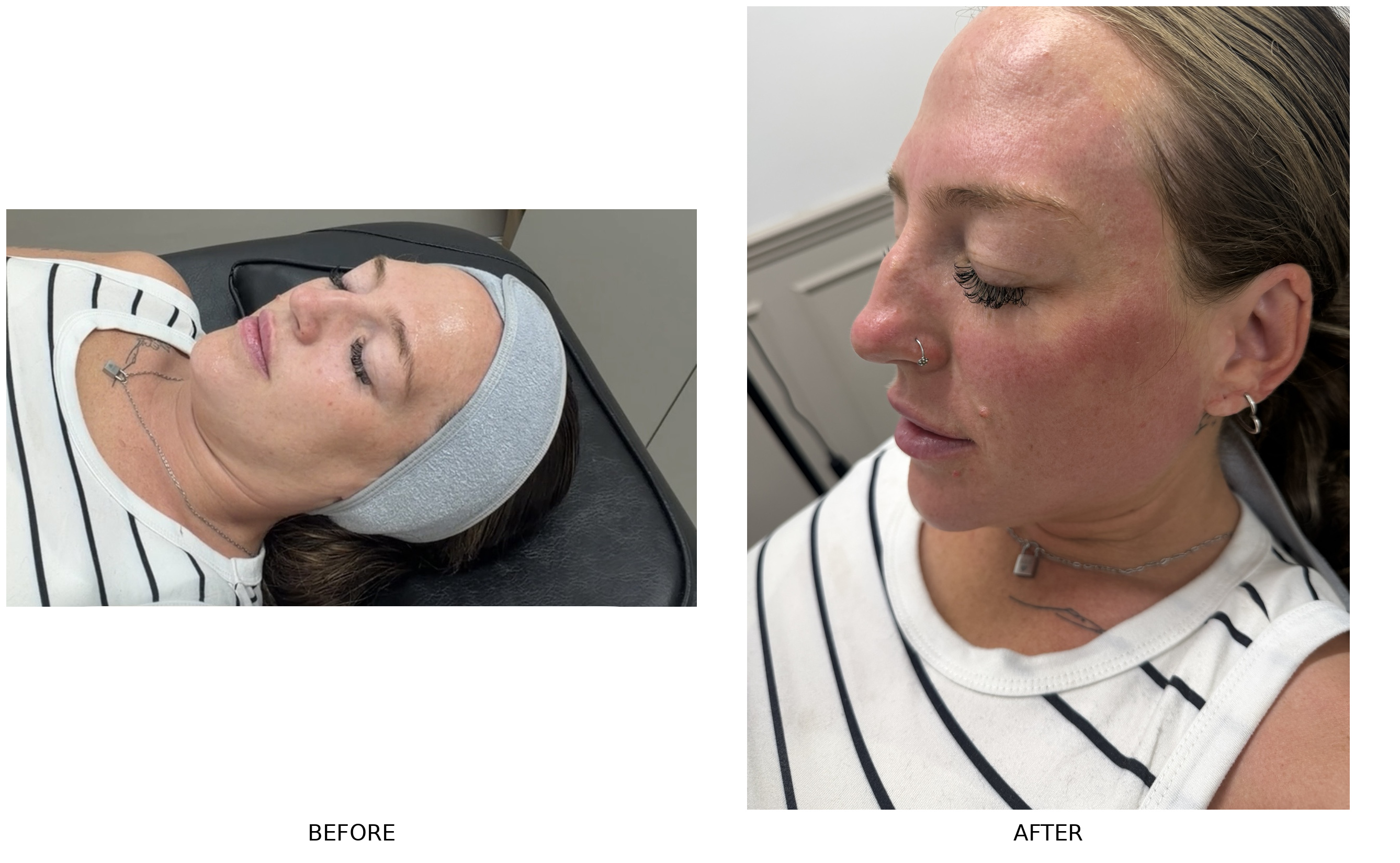 Before and after deluxe dermaplaning and meso-tox microneedling