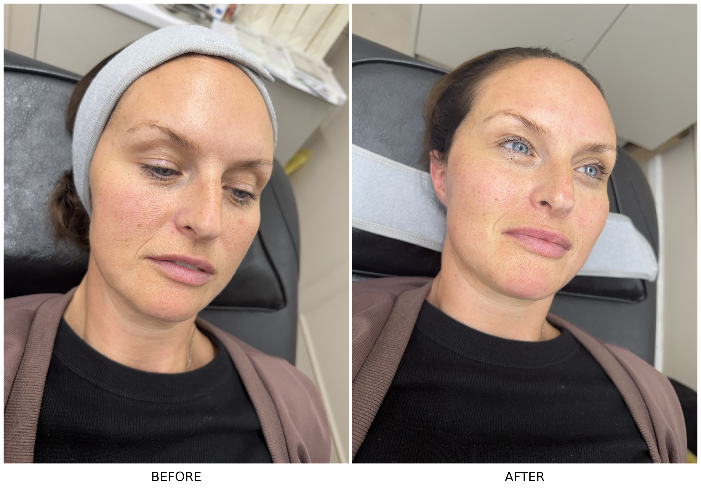 Before and after Glass Facial