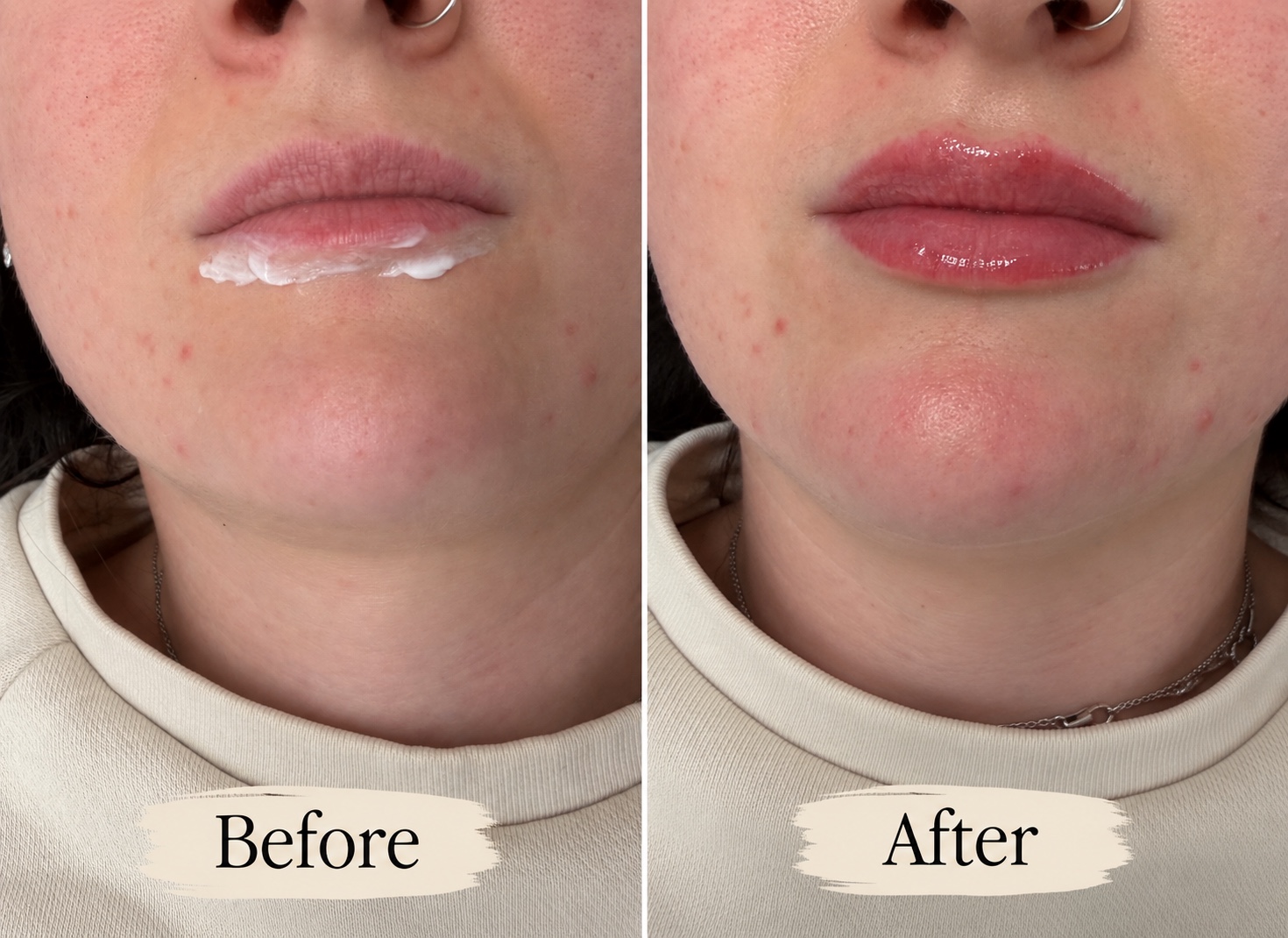 Before and after lip enhancement